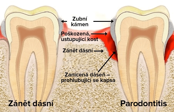 zanet dasni parodontoza